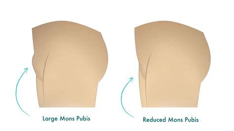 large pubic mound|Mons pubis .